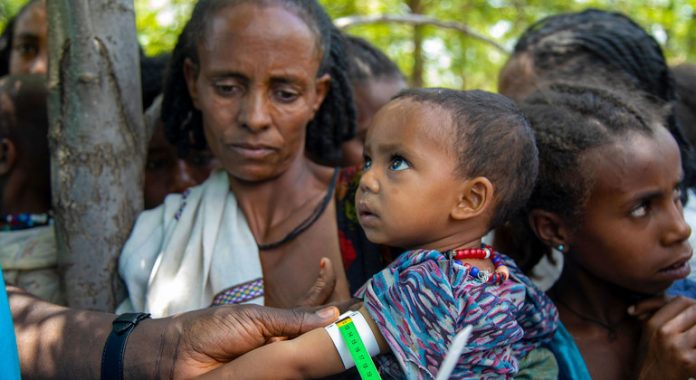undernourished child in Ethiopia